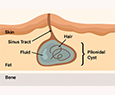 Pilonidal Sinus