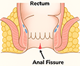 Anal Fissure