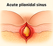 Acute Pilonidal Sinus