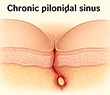 Chronic Pilonidal Sinus