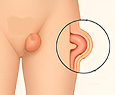 Femoral Hernia
