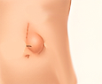 Incisional Hernia