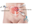 Laparoscopic Appendectomy