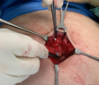 Open Appendectomy