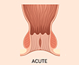 Acute Anal Fissures