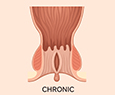 Chronic Anal Fissures