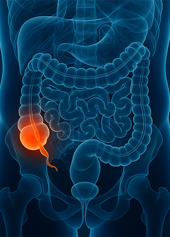 Symptoms of Appendicitis