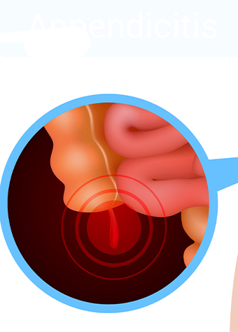 Risk Factors of Appendicitis