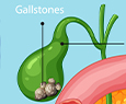 Surgical Treatments for Gallstones