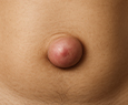What is an Umbilical Hernia?